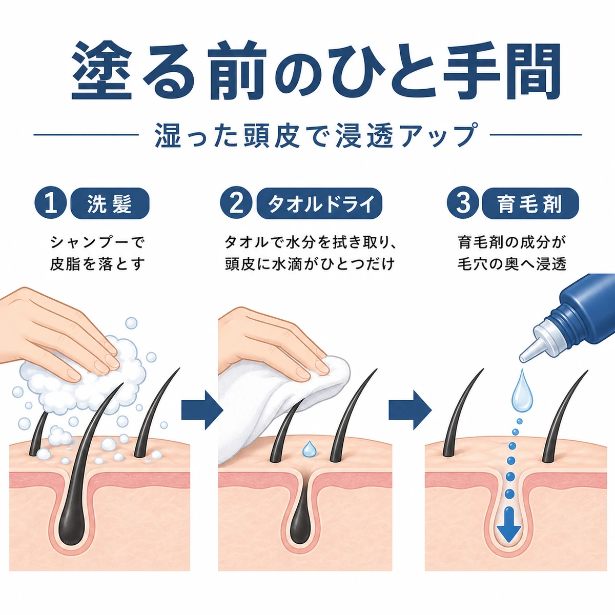 洗髪からタオルドライを経て湿った頭皮に育毛剤を塗る準備の流れを示した医療イラスト