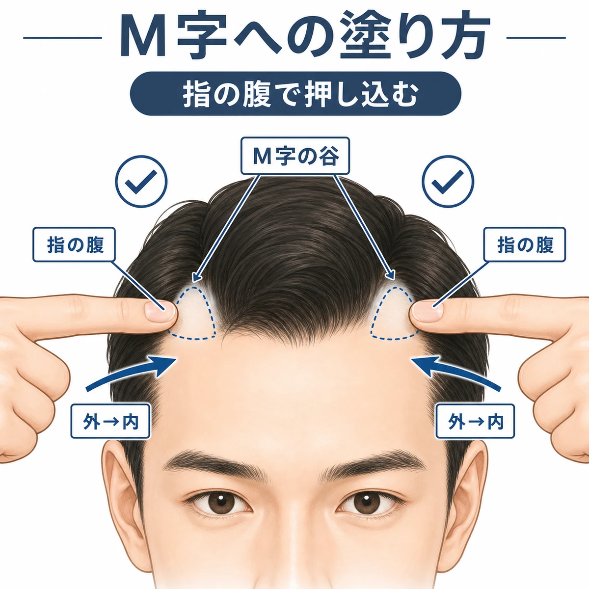 M字の谷に指の腹で外側から内側へ育毛剤を塗る動きを表した医療イラスト