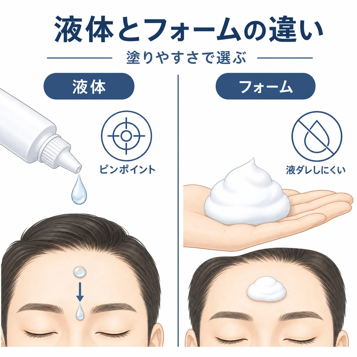 液体タイプとフォームタイプの育毛剤の特徴を左右で比べた医療イラスト