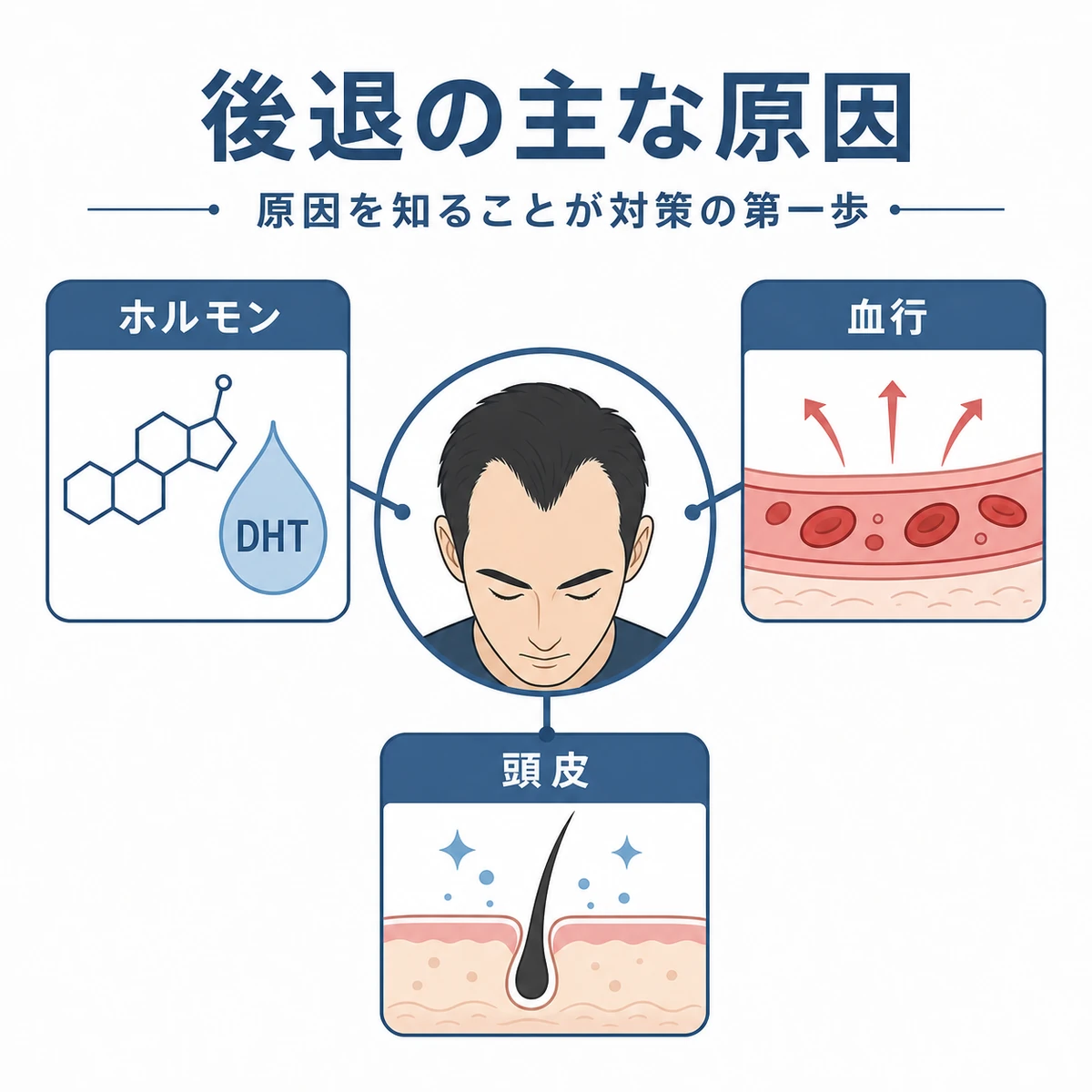 生え際の後退に関わる主な原因を相関図で表した医療イラスト