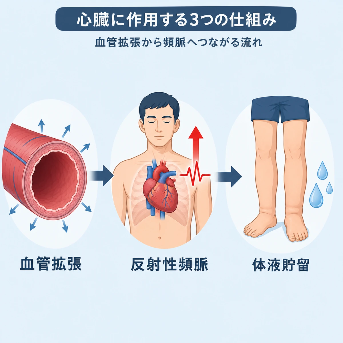 ミノキシジルが血管拡張から頻脈や体液貯留につながる仕組みを段階で示した医療イラスト