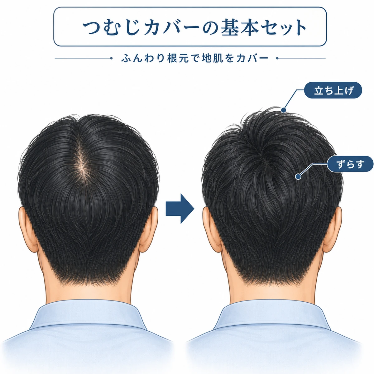 分け目をずらし根元を立ち上げてつむじの地肌を目立たなくするセット方法を表した医療メディア向けイラスト