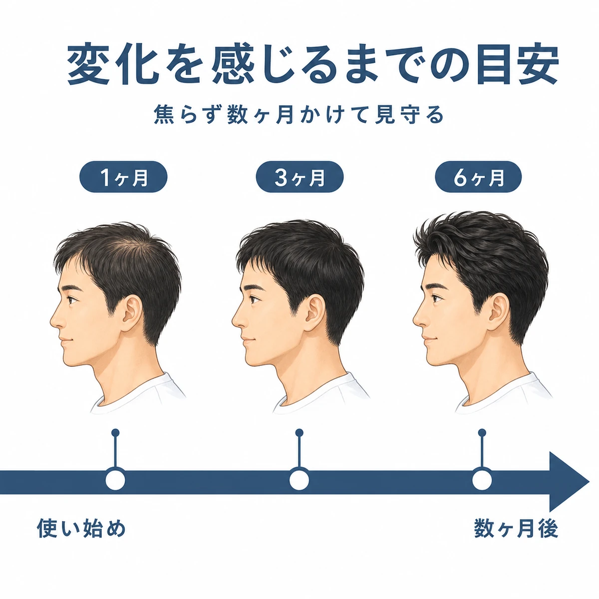育毛剤を使い始めてから数ヶ月かけて髪に変化が現れるまでの時間の流れを表した医療イラスト