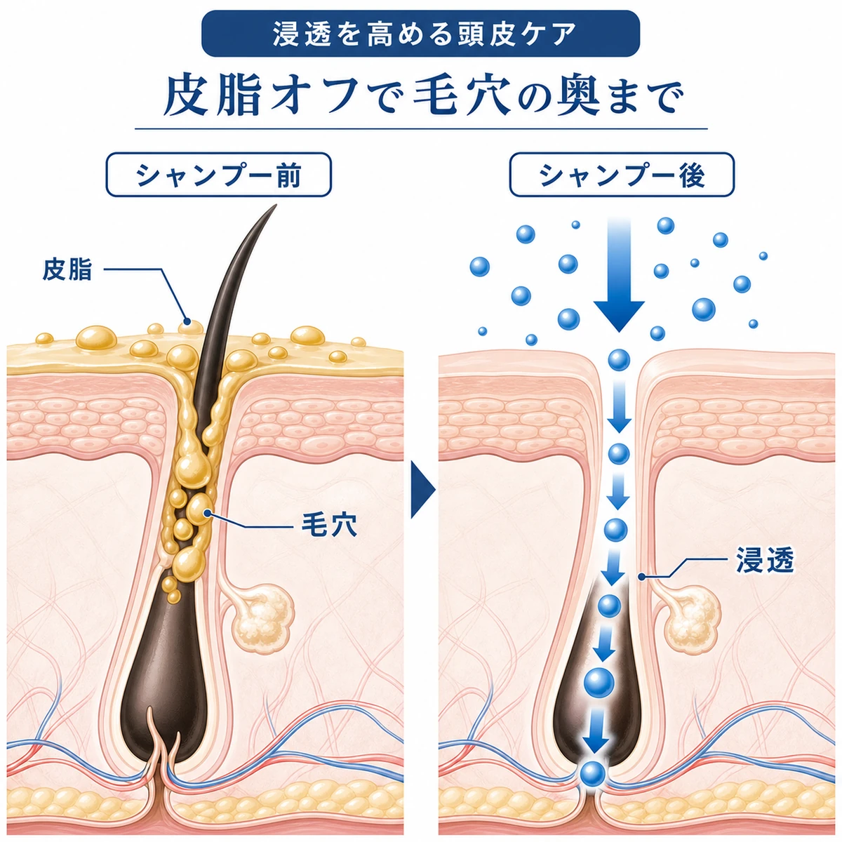シャンプーで皮脂を落とした頭皮に育毛剤の成分が毛穴の奥へ浸透する断面を表した医療イラスト