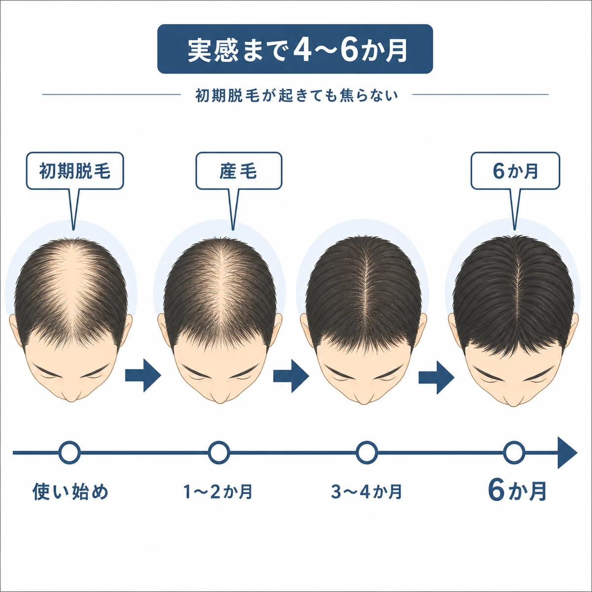 育毛剤を4〜6か月継続して髪が少しずつ変化する時間の流れを表した医療イラスト