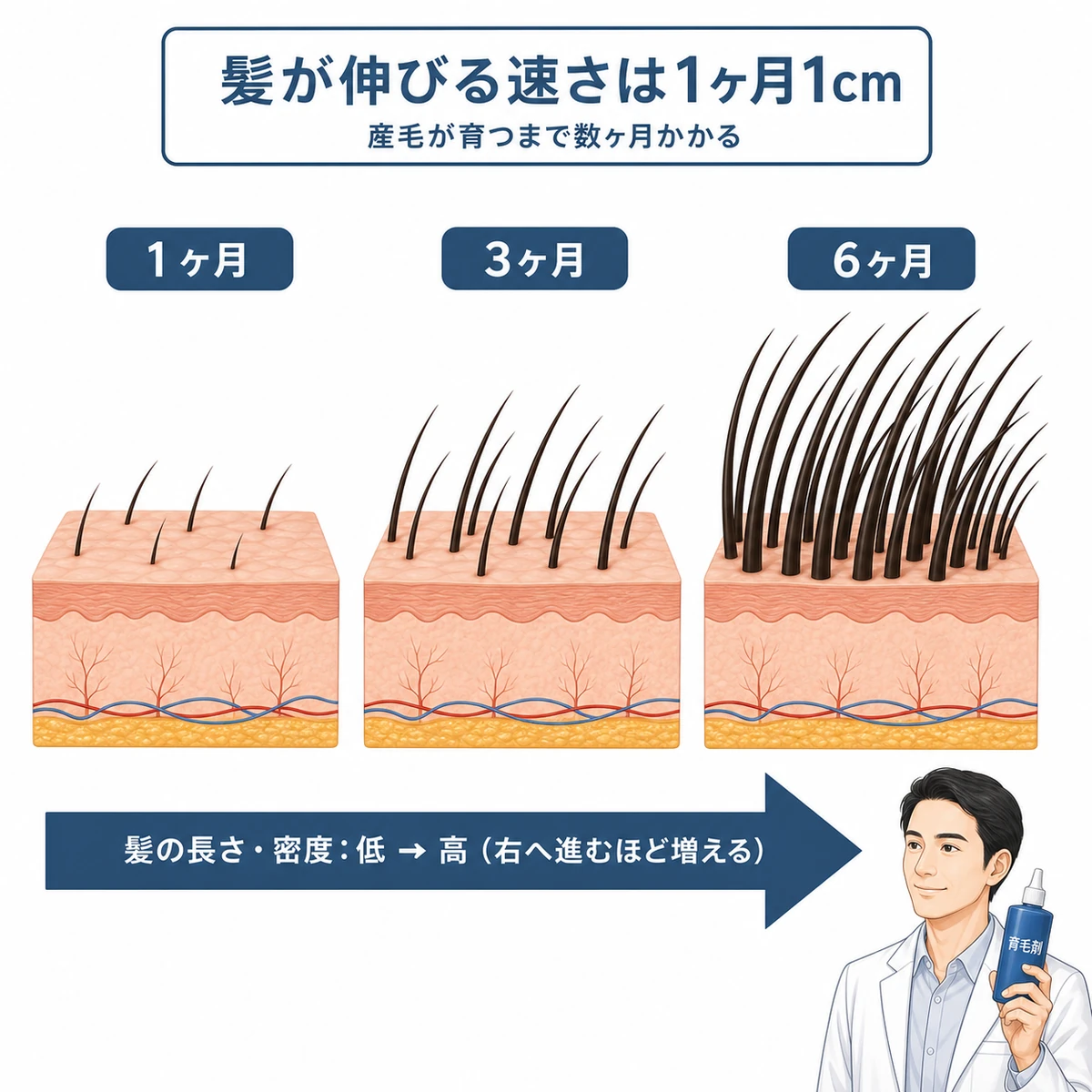 髪が月ごとに少しずつ伸びてボリュームが戻る成長速度を表した医療イラスト