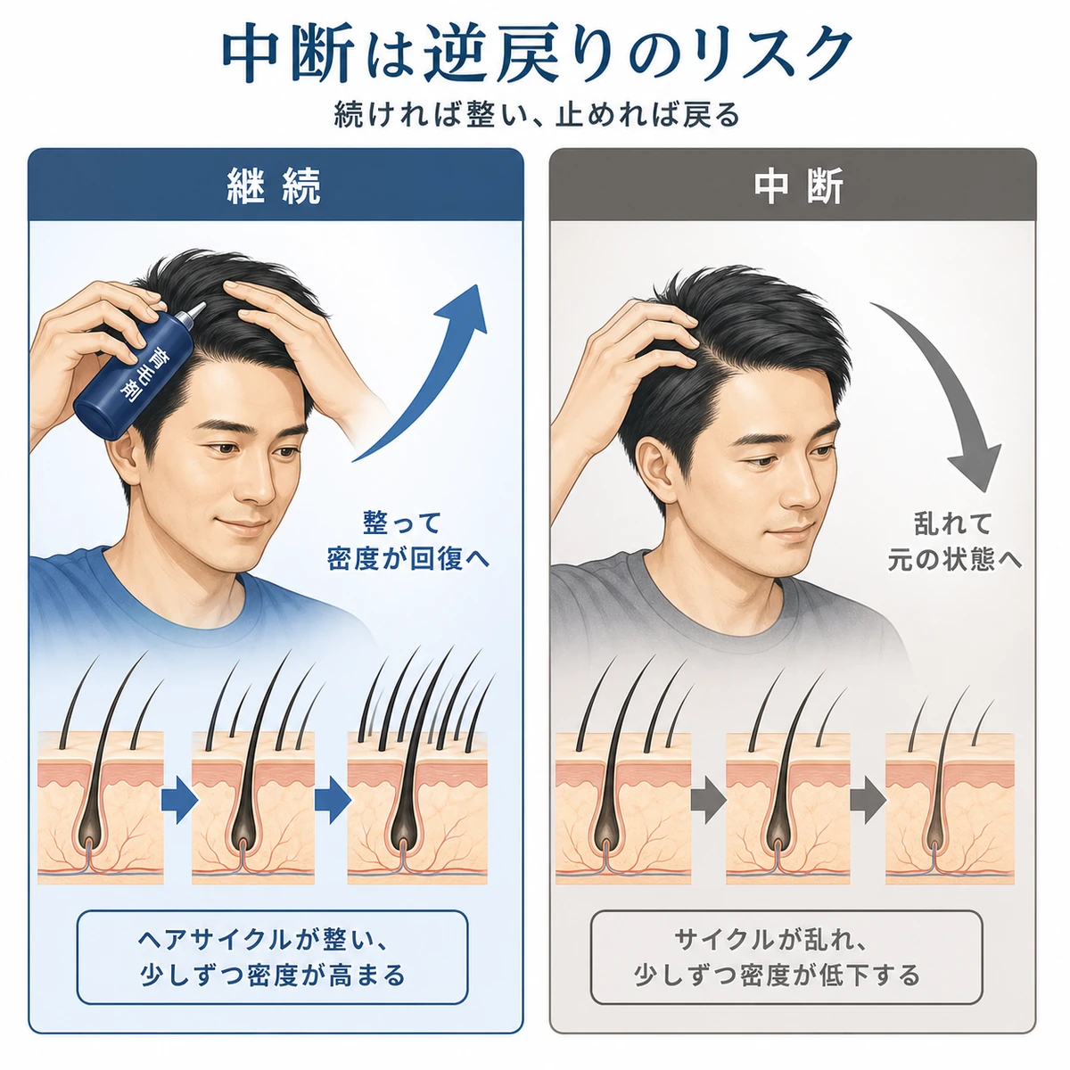 育毛剤を継続した場合と中断した場合のヘアサイクルの違いを対比した医療イラスト
