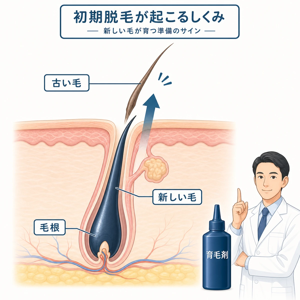 毛穴の中で新しい毛が古い毛を下から押し上げる初期脱毛のしくみを表した医療イラスト