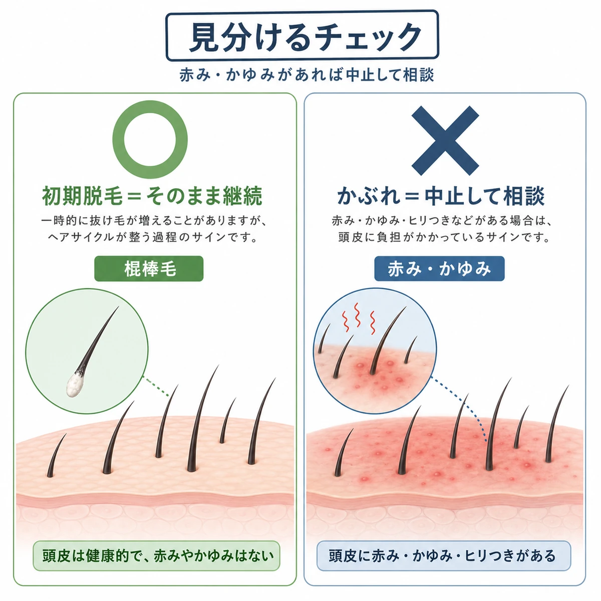 初期脱毛の棍棒毛と頭皮のかぶれを○×で見分ける医療イラスト