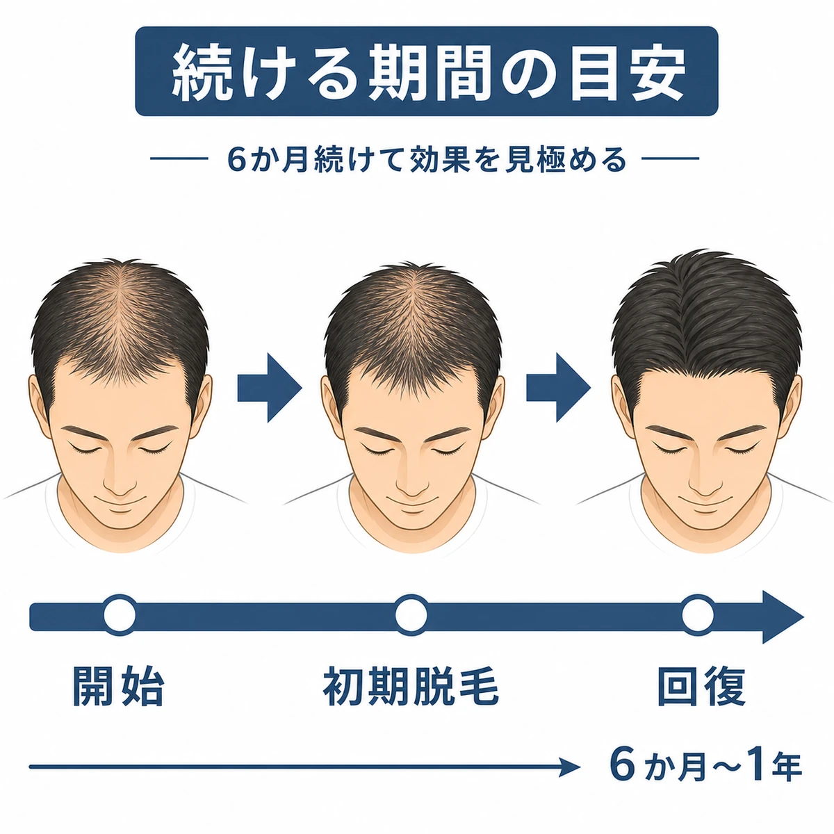 育毛剤を6か月続けると毛髪が回復に向かう経過を左から右へ表した医療イラスト
