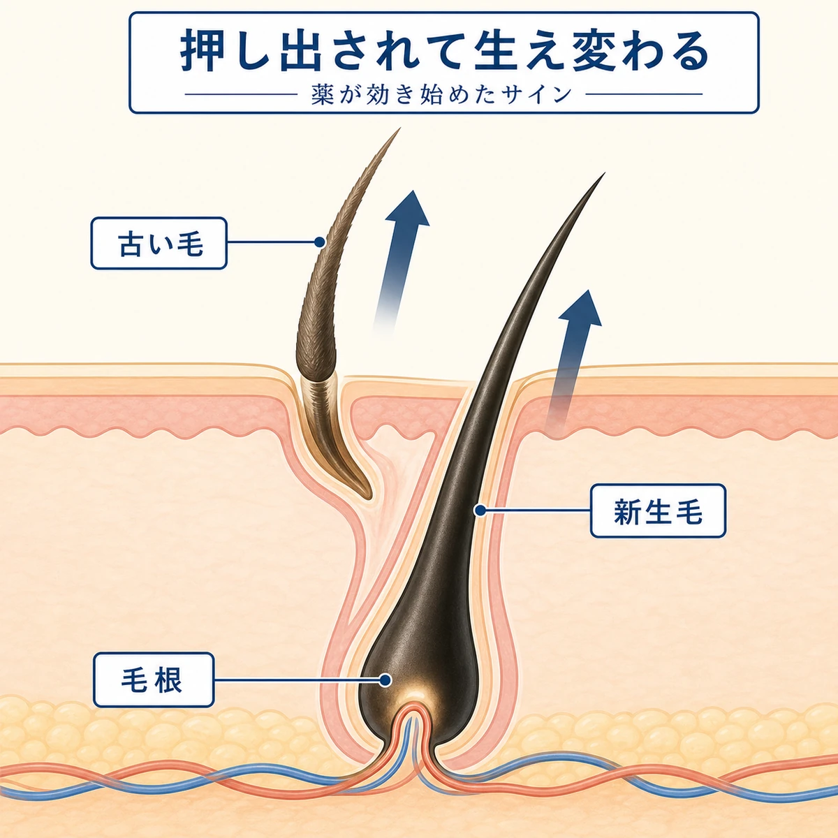 毛包の断面で古い毛が新生毛に押し出されて生え変わる仕組みを表した医療イラスト