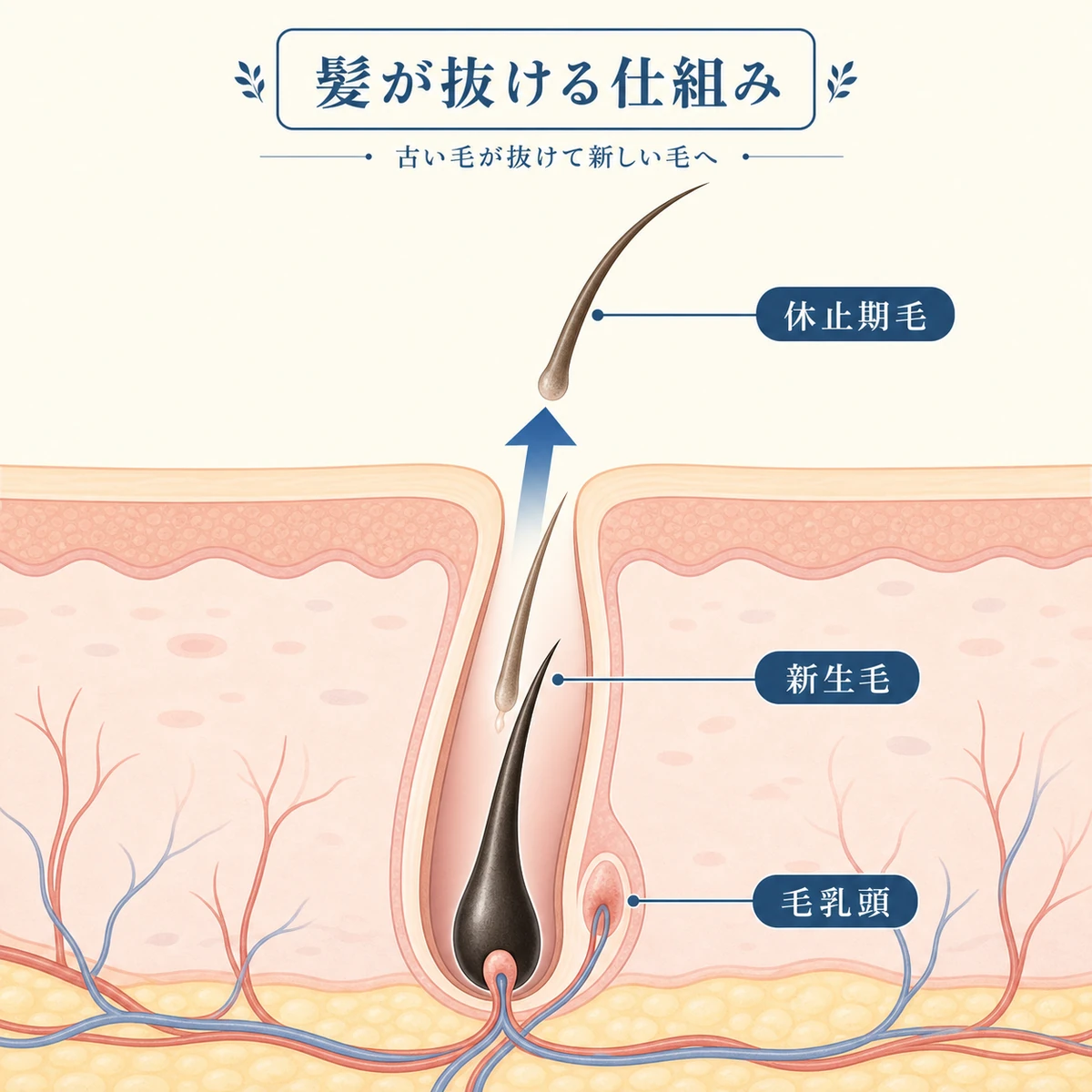 毛穴の中で新しい毛が古い休止期の毛を下から押し上げて抜けていく初期脱毛の仕組みを表した医療イラスト