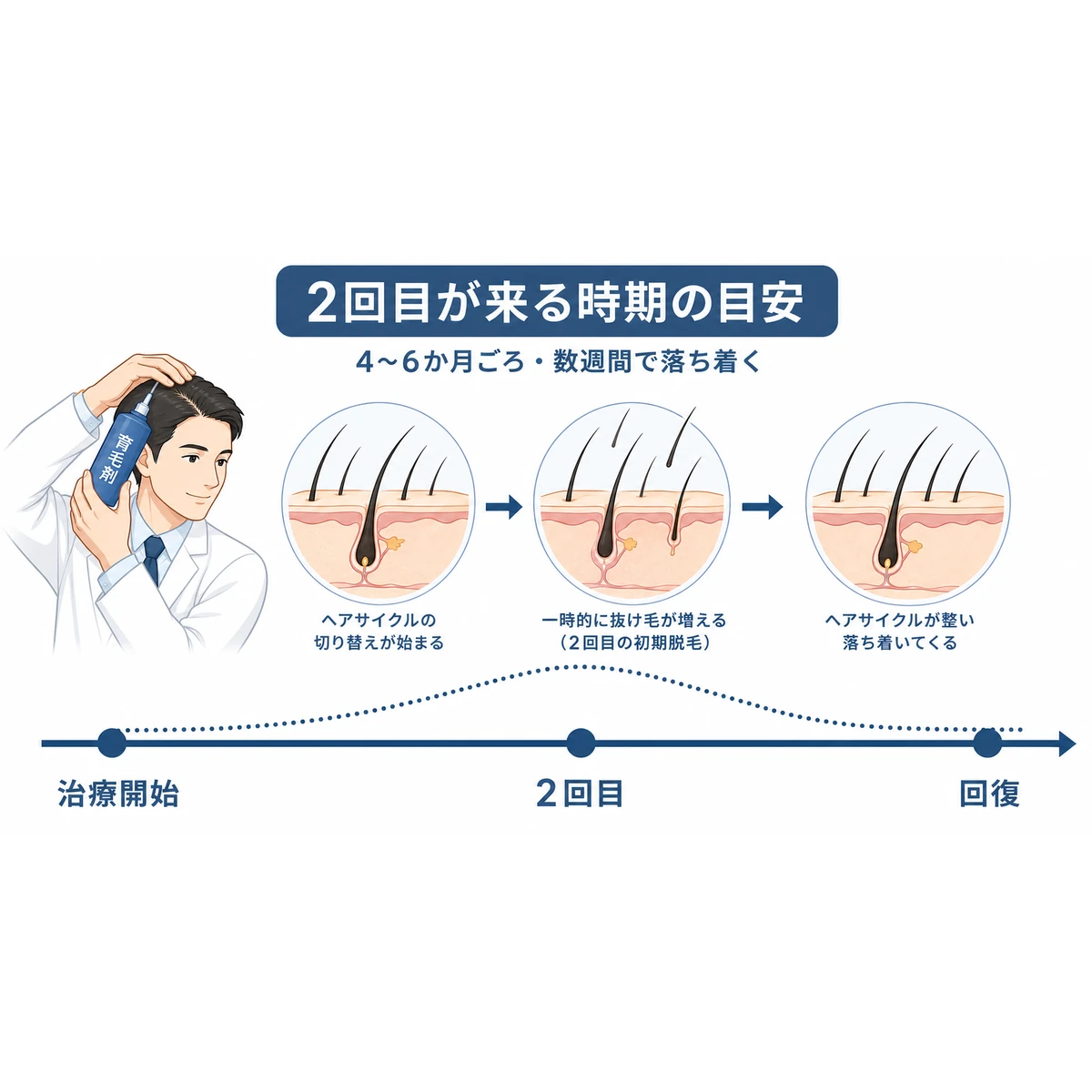 治療開始から4〜6か月ごろに2回目の抜け毛が現れ数週間で落ち着くまでの経過を左から右に表した医療イラスト