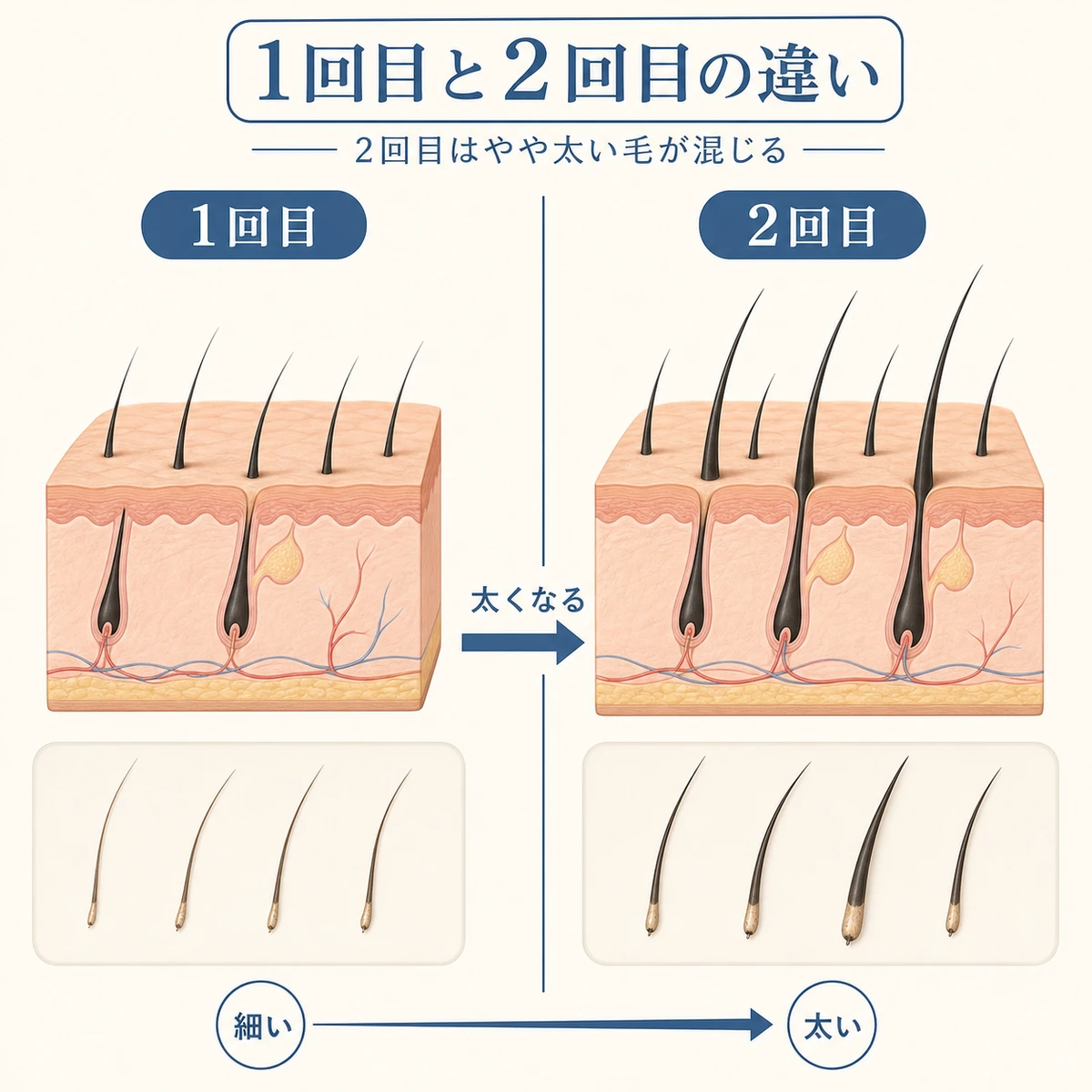 1回目の細い抜け毛と2回目のやや太い抜け毛を左右で比べ太くなっていく違いを表した医療イラスト