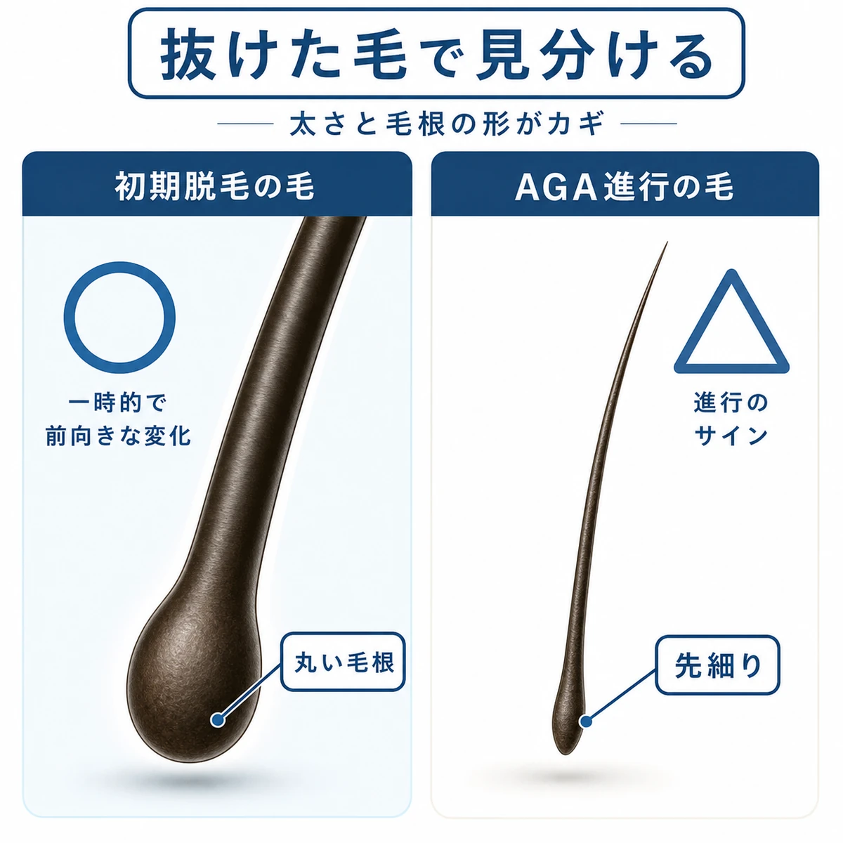 初期脱毛の太い毛とAGA進行の細い毛を毛根の形で見分ける比較を表した医療イラスト