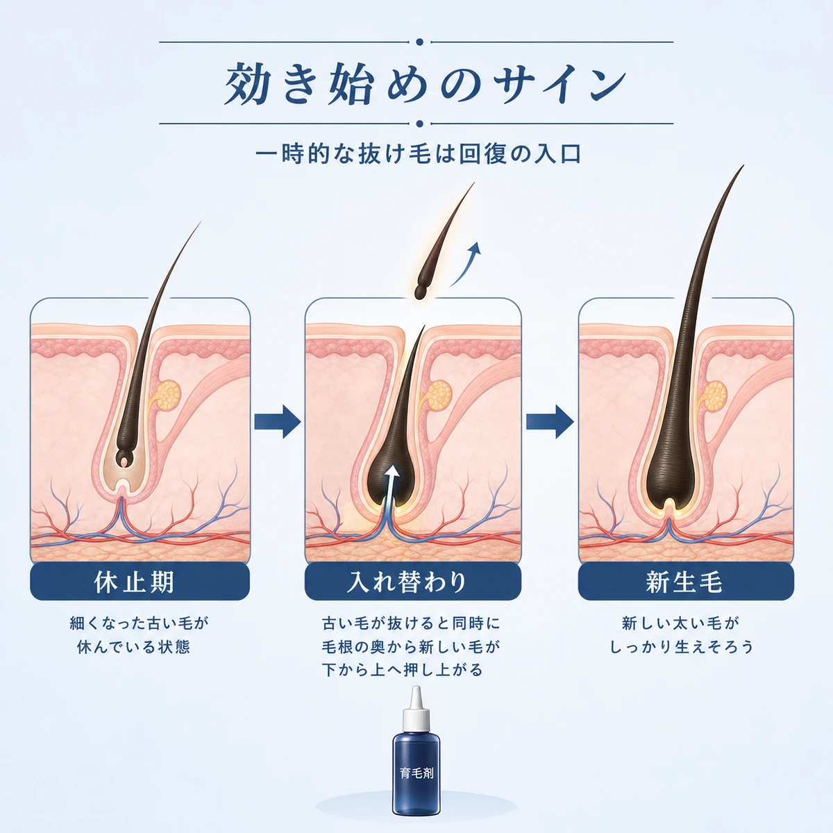 初期脱毛で古い毛が抜けて新しい毛に入れ替わる毛周期の流れを表した医療イラスト