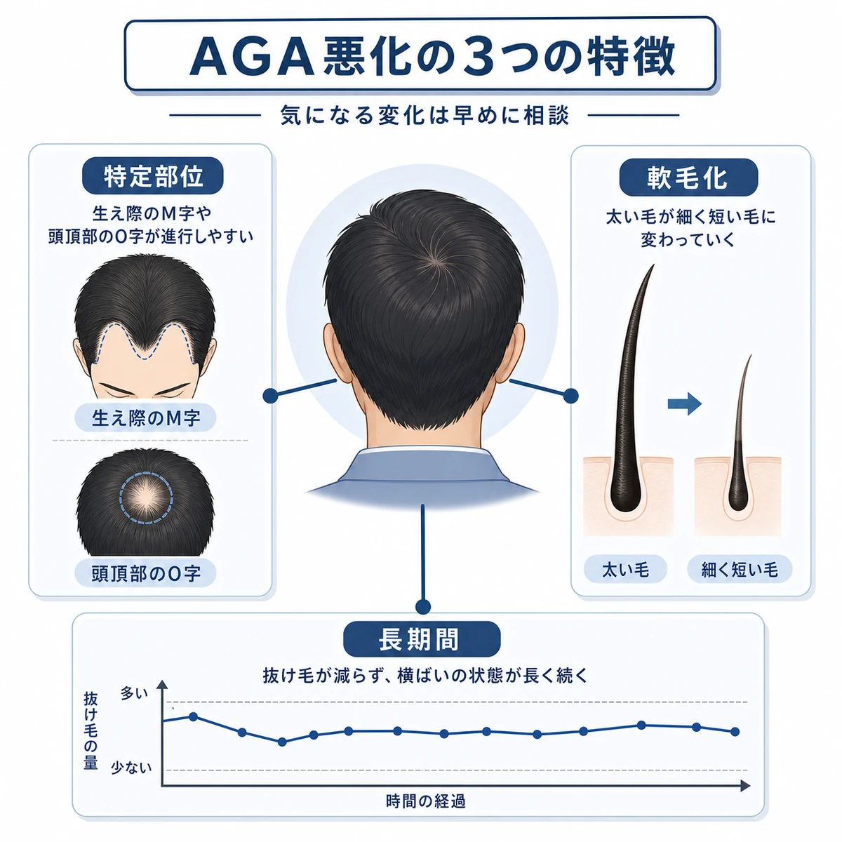 AGA悪化に見られる部位集中と軟毛化と長期化の特徴を並べた医療イラスト