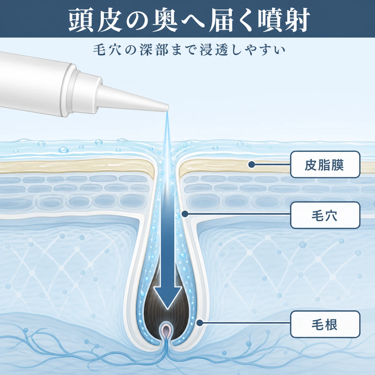 ジェットノズルの噴射が頭皮の皮脂膜を越え毛穴から毛根へ下向きに届く断面を表した医療イラスト