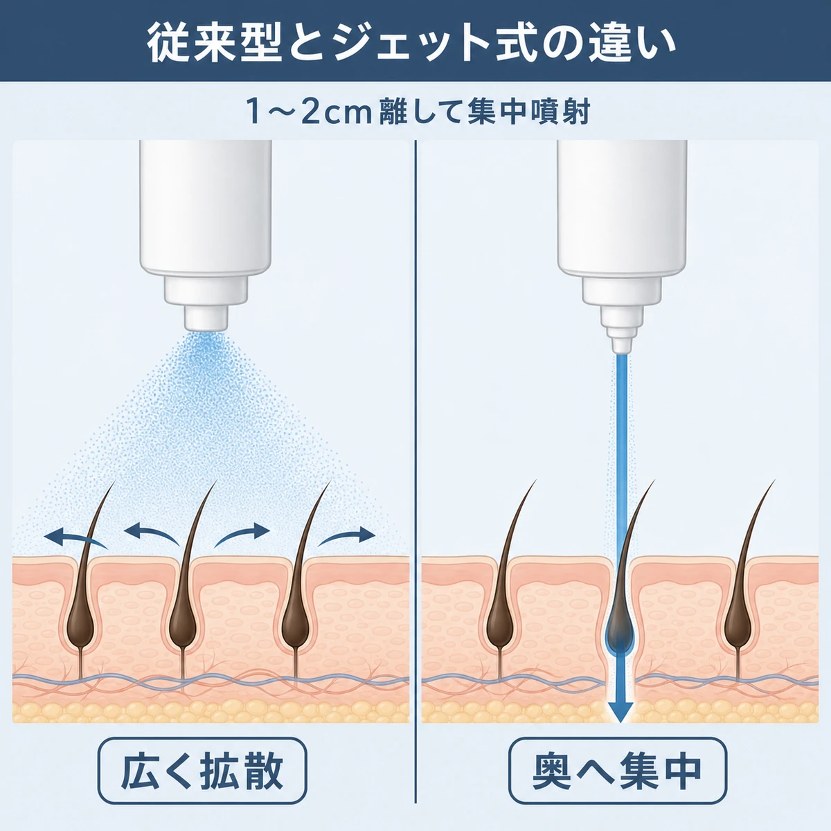 従来スプレーは表面で拡散しジェットノズルは奥へ集中して届く塗布方法の違いを表した医療イラスト