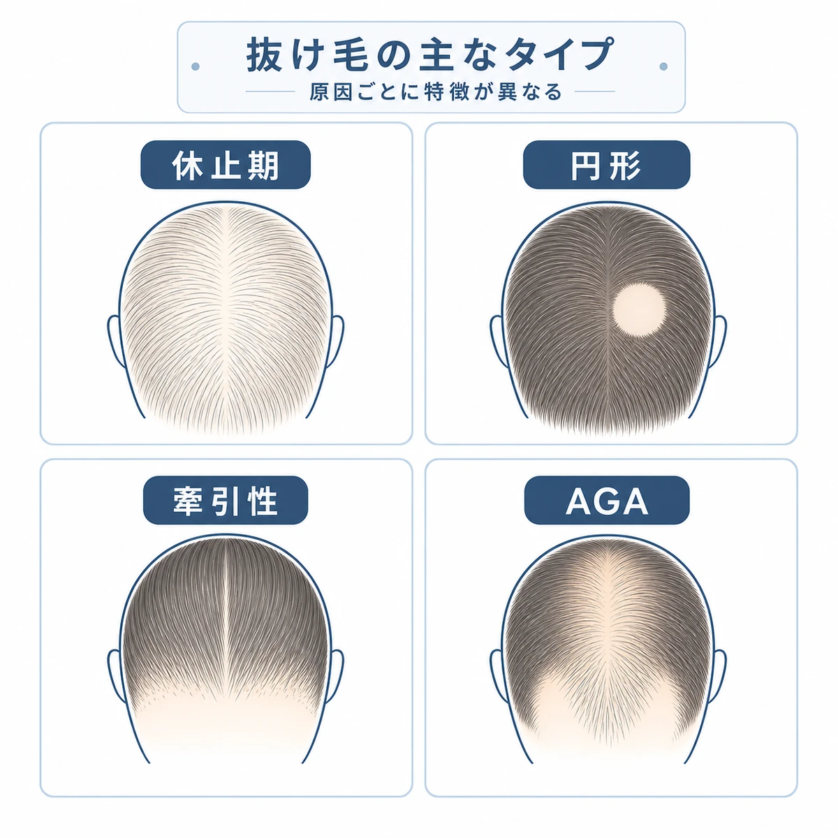 休止期・円形・牽引性・AGAという4種類の抜け毛の特徴を並べた医療イラスト
