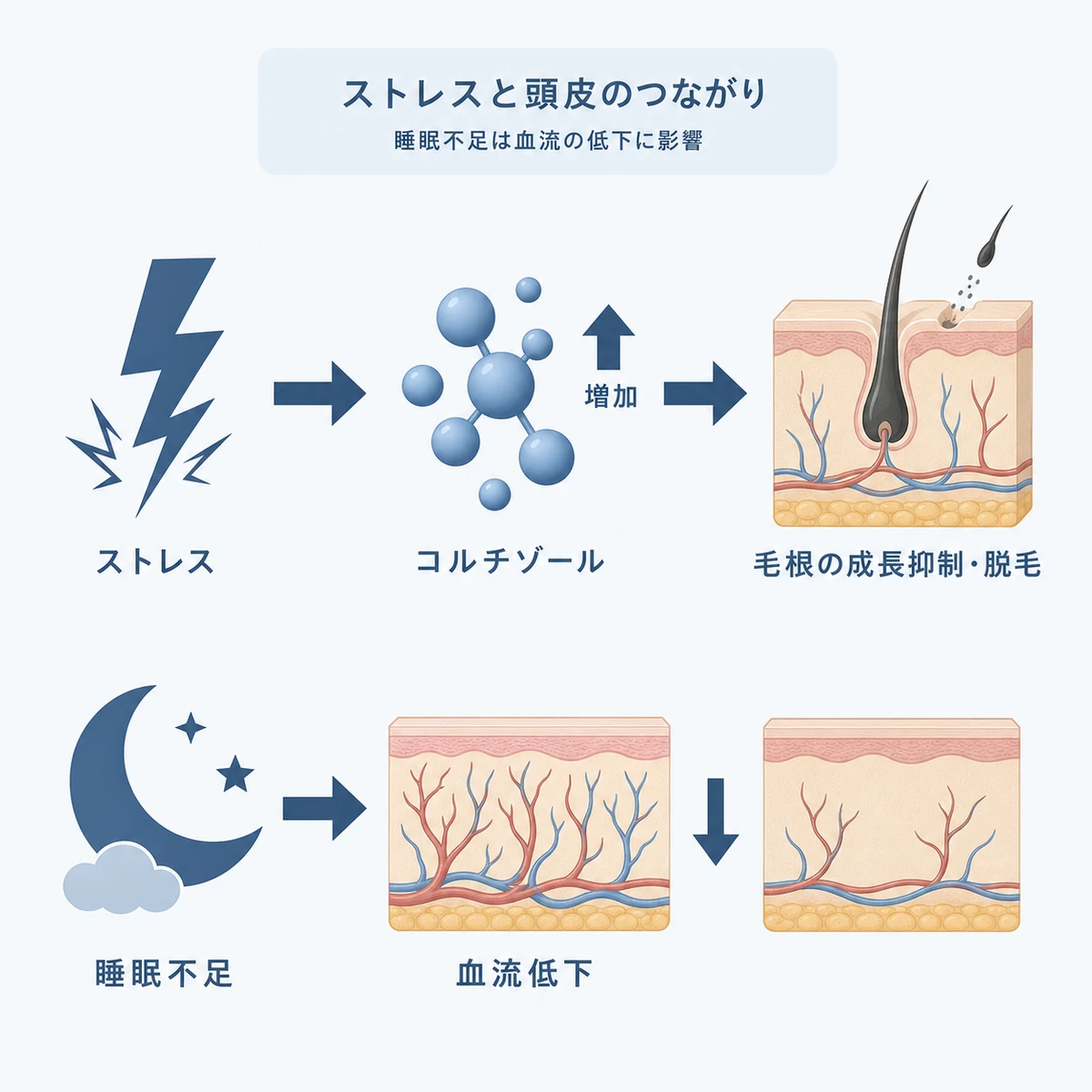ストレスでコルチゾールが増え睡眠不足で頭皮の血流が下がる流れを表した医療イラスト