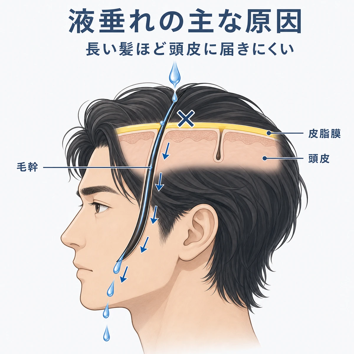 長い髪を伝って育毛剤が頭皮に届かず流れ落ちる原因を表した医療イラスト