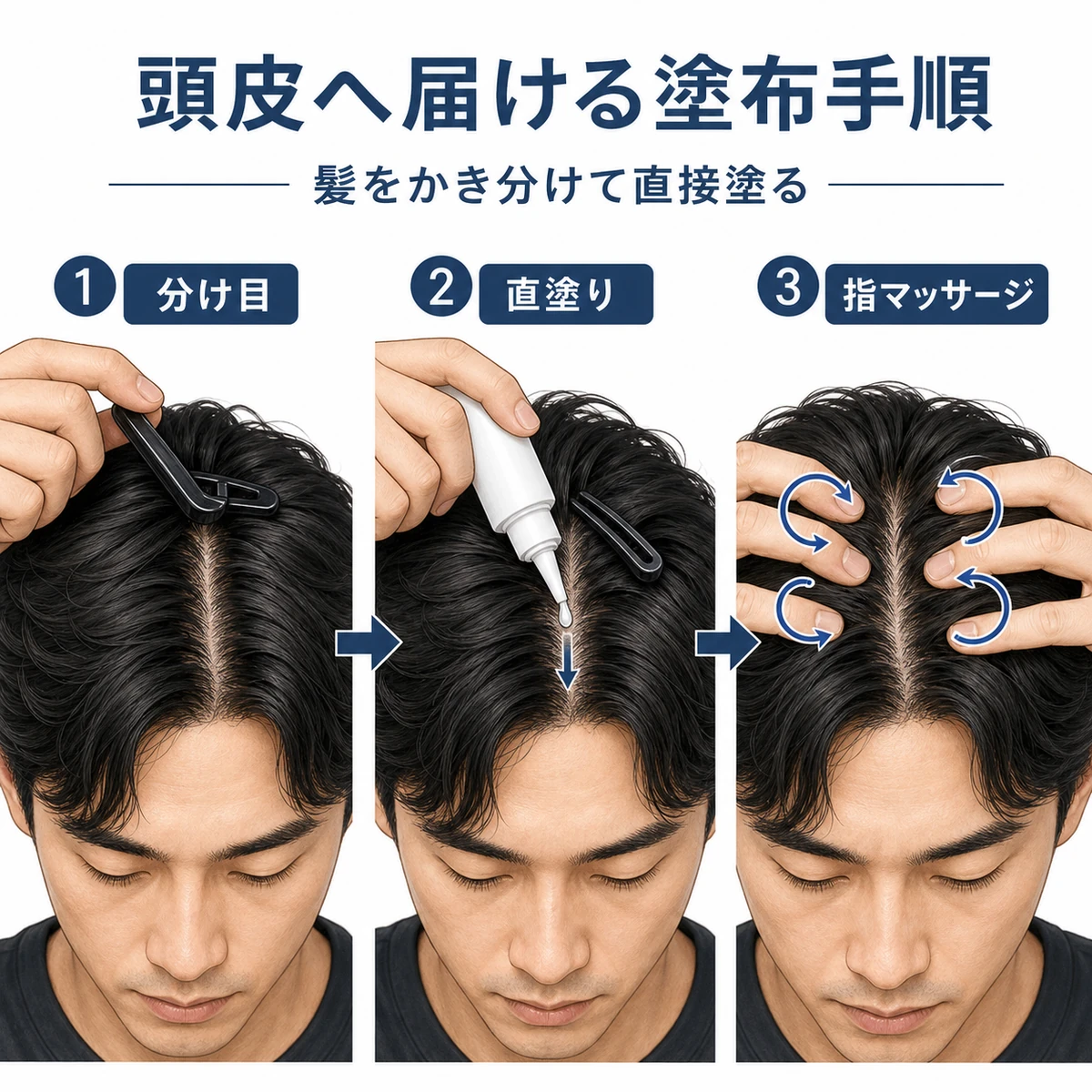 髪をかき分けてノズルを密着させ頭皮へ育毛剤を届ける塗布手順を表した医療イラスト