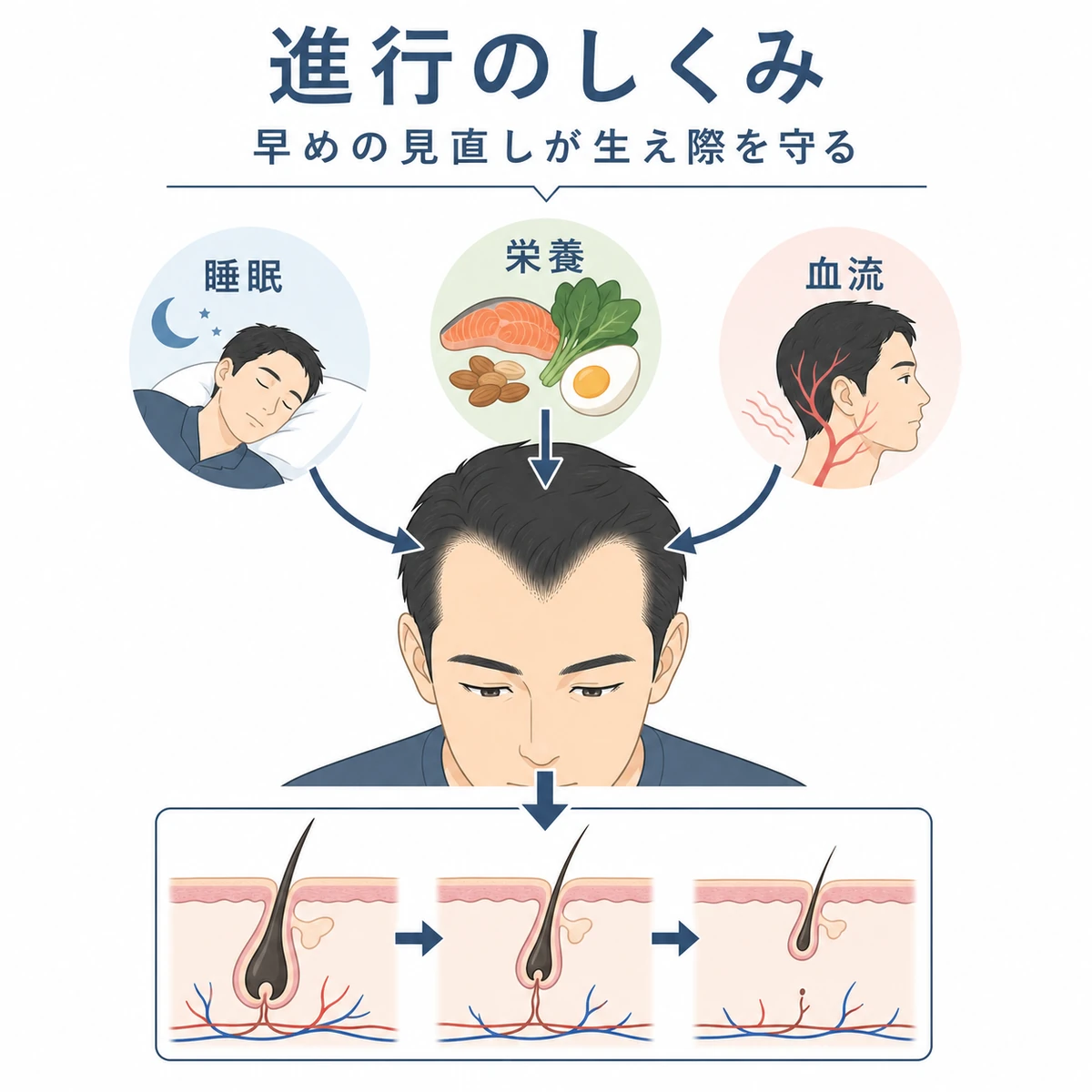 AGAと生活習慣が生え際の後退に関わる仕組みを表した医療イラスト
