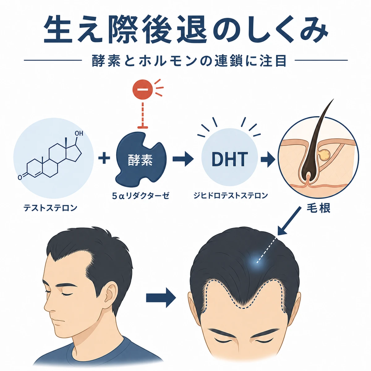 テストステロンが5αリダクターゼでDHTに変わり生え際の後退につながる流れを表した医療イラスト