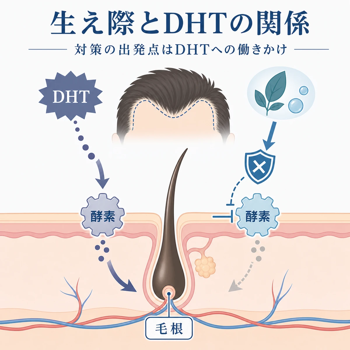 生え際の後退とDHT、対策成分の分岐を表した医療イラスト