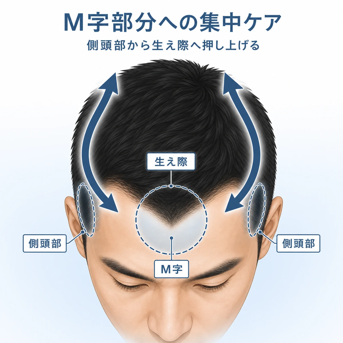 側頭部から生え際へ血液を押し上げM字部分を集中ケアする流れを示した医療イラスト