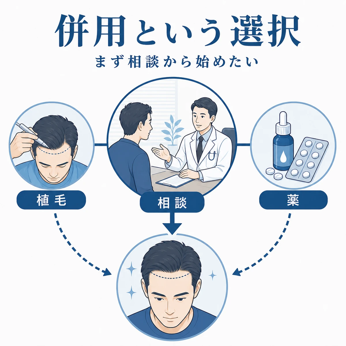 植毛と育毛剤を組み合わせて生え際を保つ治療戦略の関係を表した医療イラスト