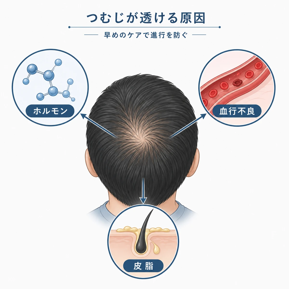 つむじの地肌が透ける主な原因を頭頂部の俯瞰図でまとめた男性向け医療イラスト