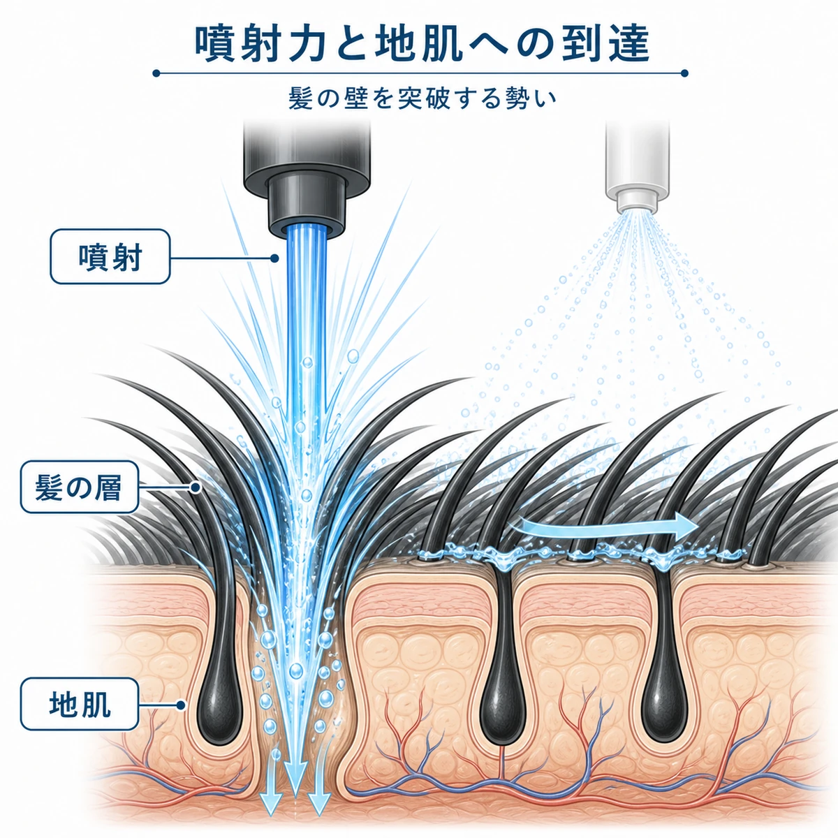 強い噴射が髪の層を突き抜けて地肌の毛穴に届く仕組みを表した頭皮断面の医療イラスト