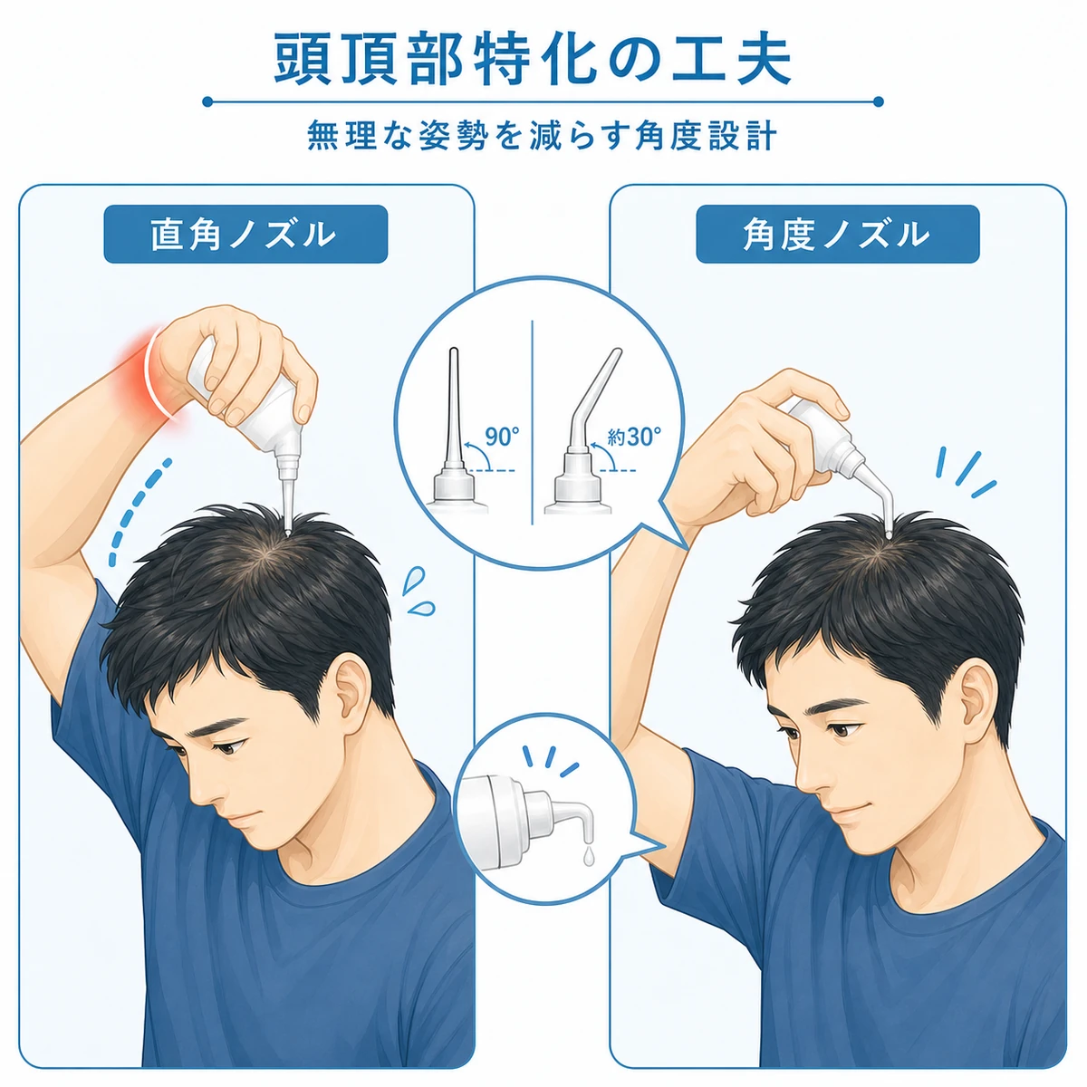 垂直ノズルと角度付きノズルで頭頂部を塗るときの姿勢の違いを比べた医療イラスト