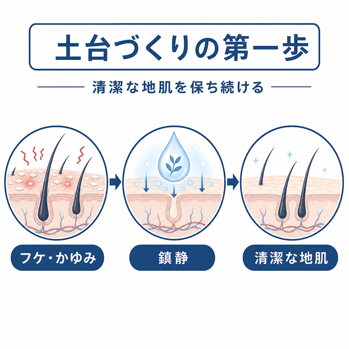フケやかゆみが鎮まり清潔な地肌の土台が整う流れを表した医療イラスト