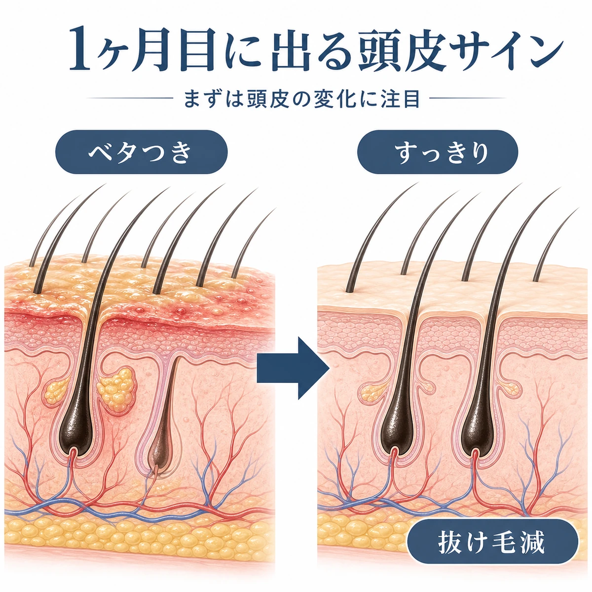 使用前と1ヶ月後の頭皮コンディションの違いを左右で比べた男性向け育毛の医療イラスト