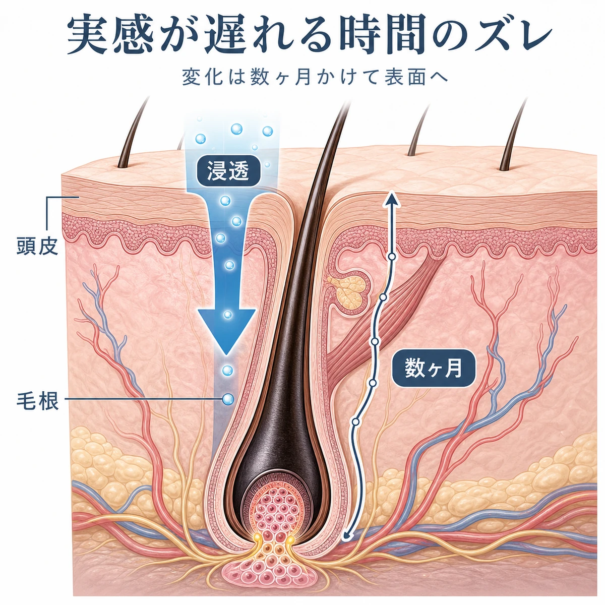 頭皮の断面で成分が毛根へ下向きに浸透し髪が表面に出るまで時間差があることを表した医療イラスト