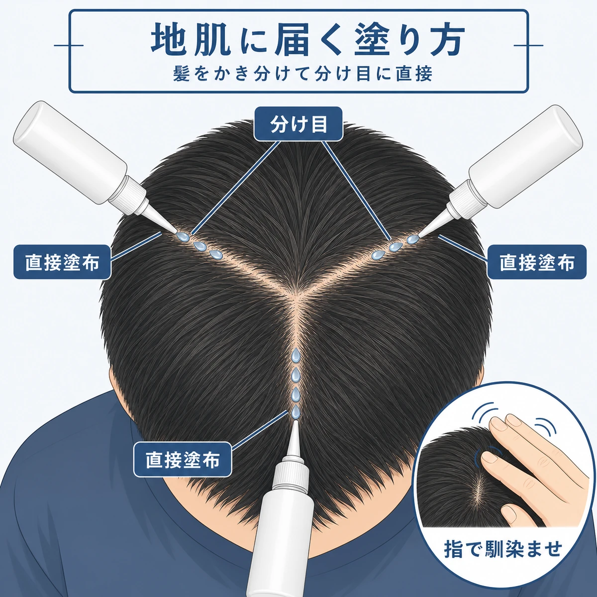 頭頂部を上から見て分け目に沿って育毛剤を地肌へ塗り広げる手順を表した医療イラスト