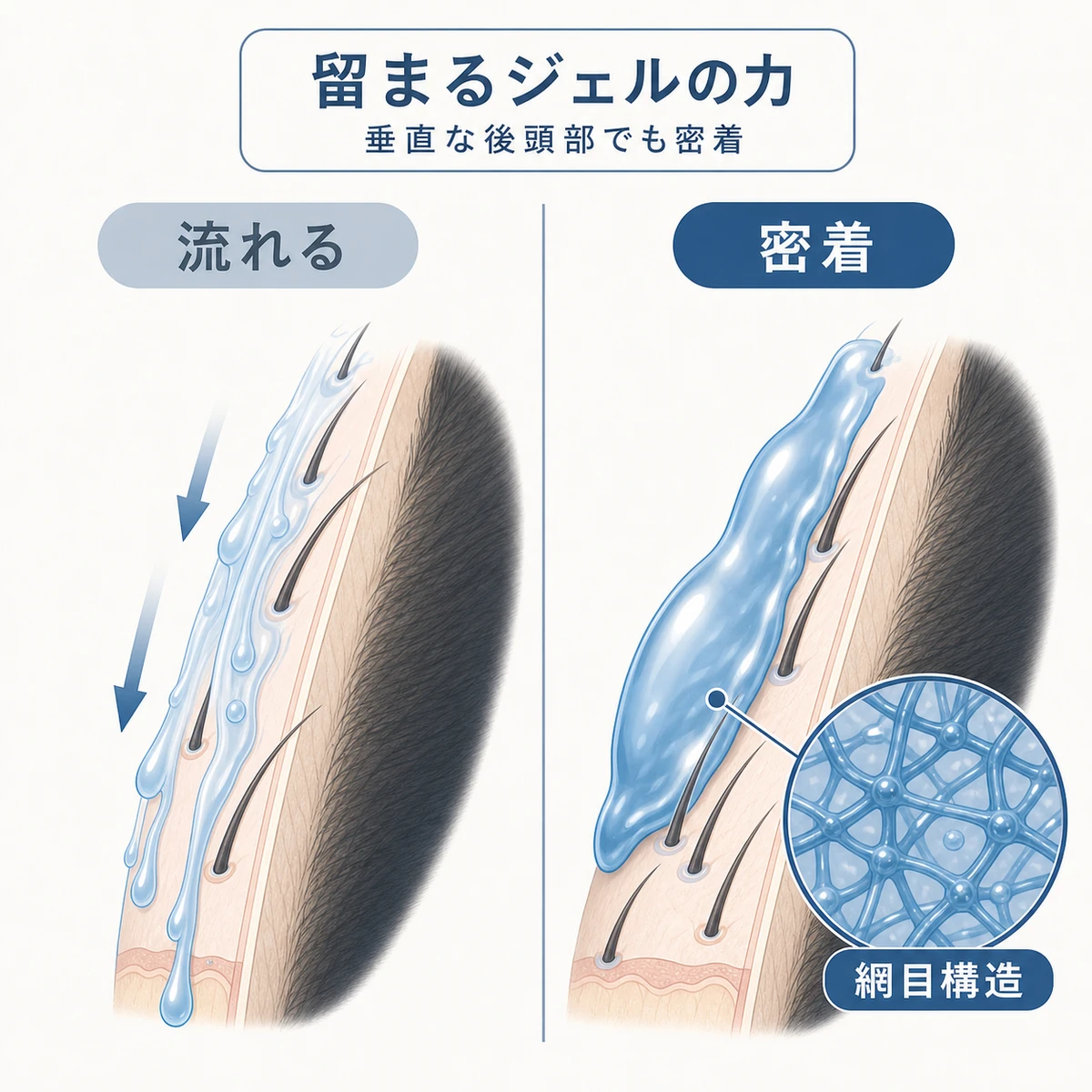 水状の液体は流れ落ち高粘度ジェルは頭皮に密着して留まる違いを比較した医療イラスト