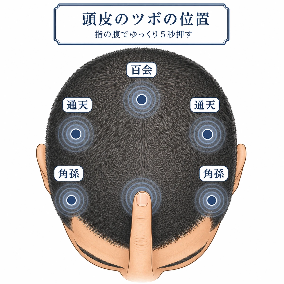 百会や角孫や通天など頭皮の主要なツボの位置を頭頂から見た図で表した医療イラスト