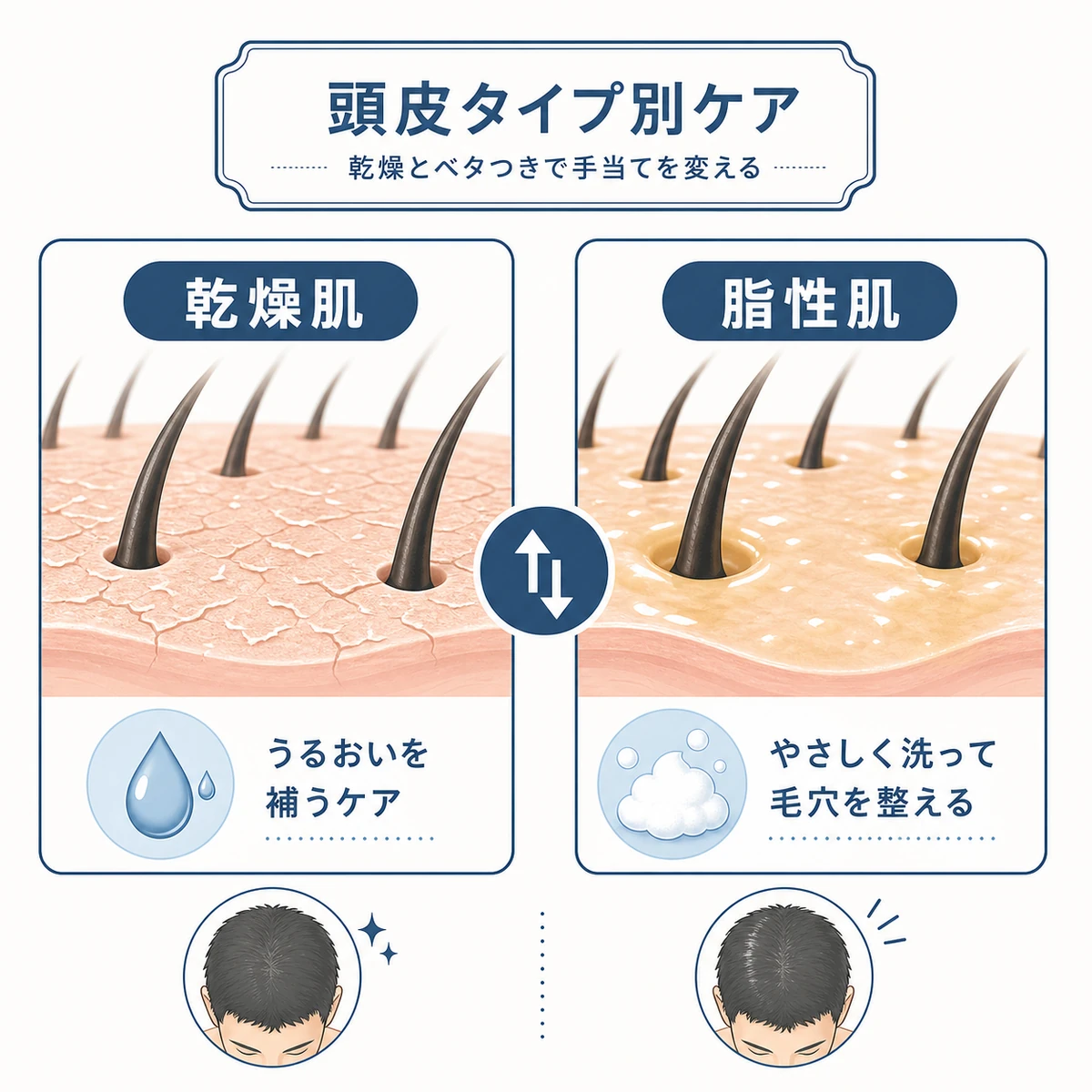 乾燥肌と脂性肌それぞれに合わせた頭皮ケアの違いを対比した医療イラスト
