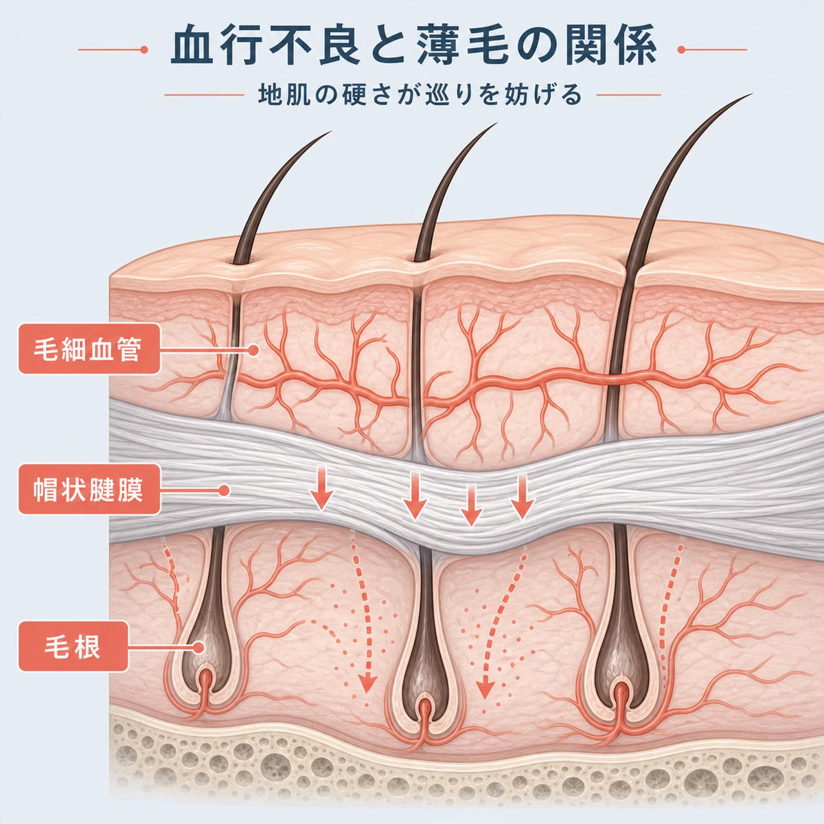 頭頂部の断面図で帽状腱膜が毛細血管を圧迫し毛根への血流が滞る仕組みを表した医療イラスト