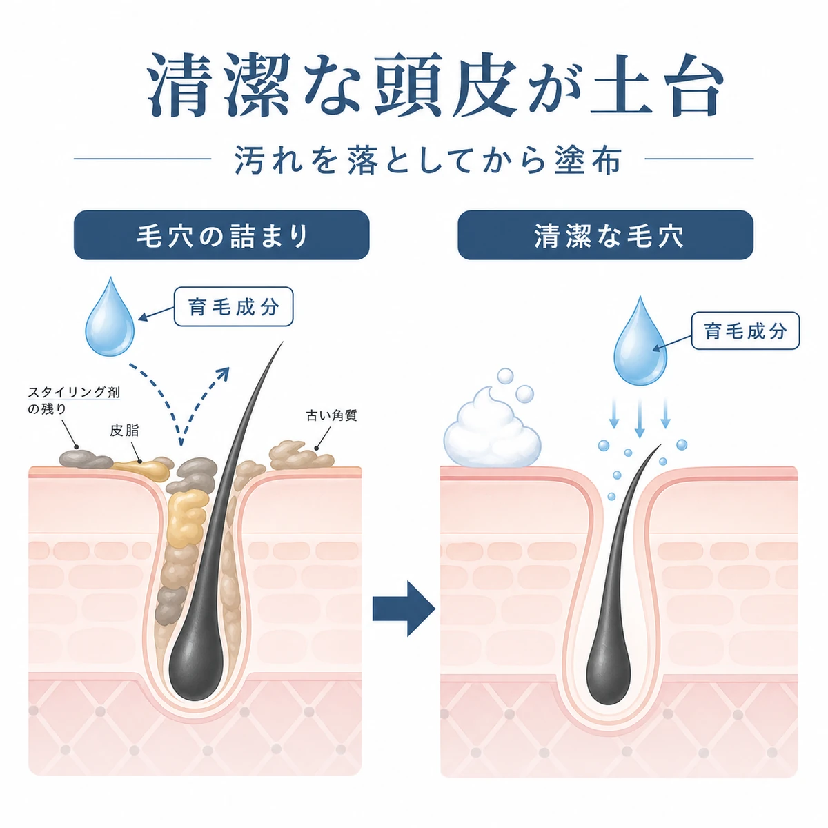 詰まった毛穴と洗浄後の清潔な毛穴で育毛成分の届き方が変わる様子を比べた医療イラスト
