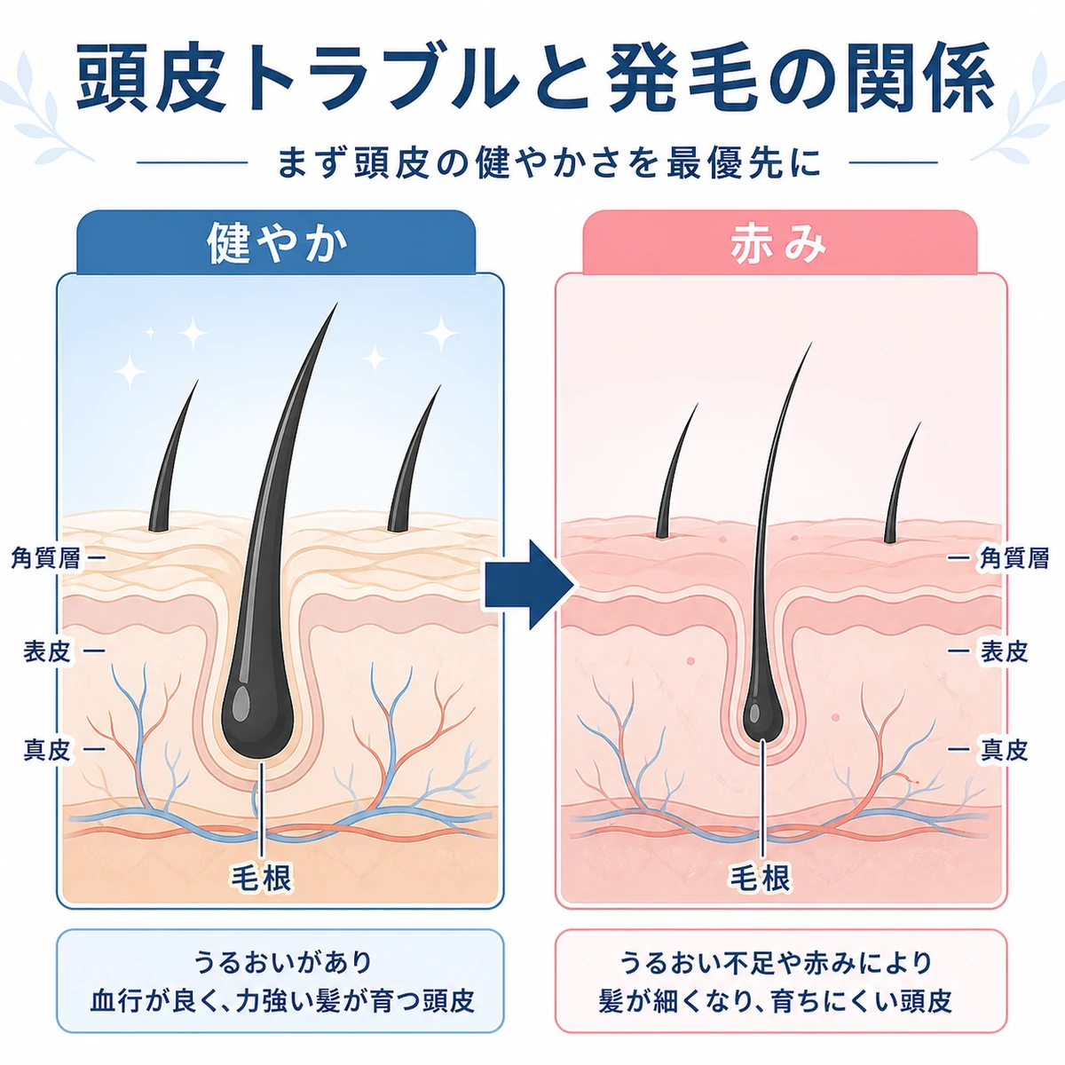 健やかな頭皮と赤みのある頭皮の断面を比べた医療イラスト
