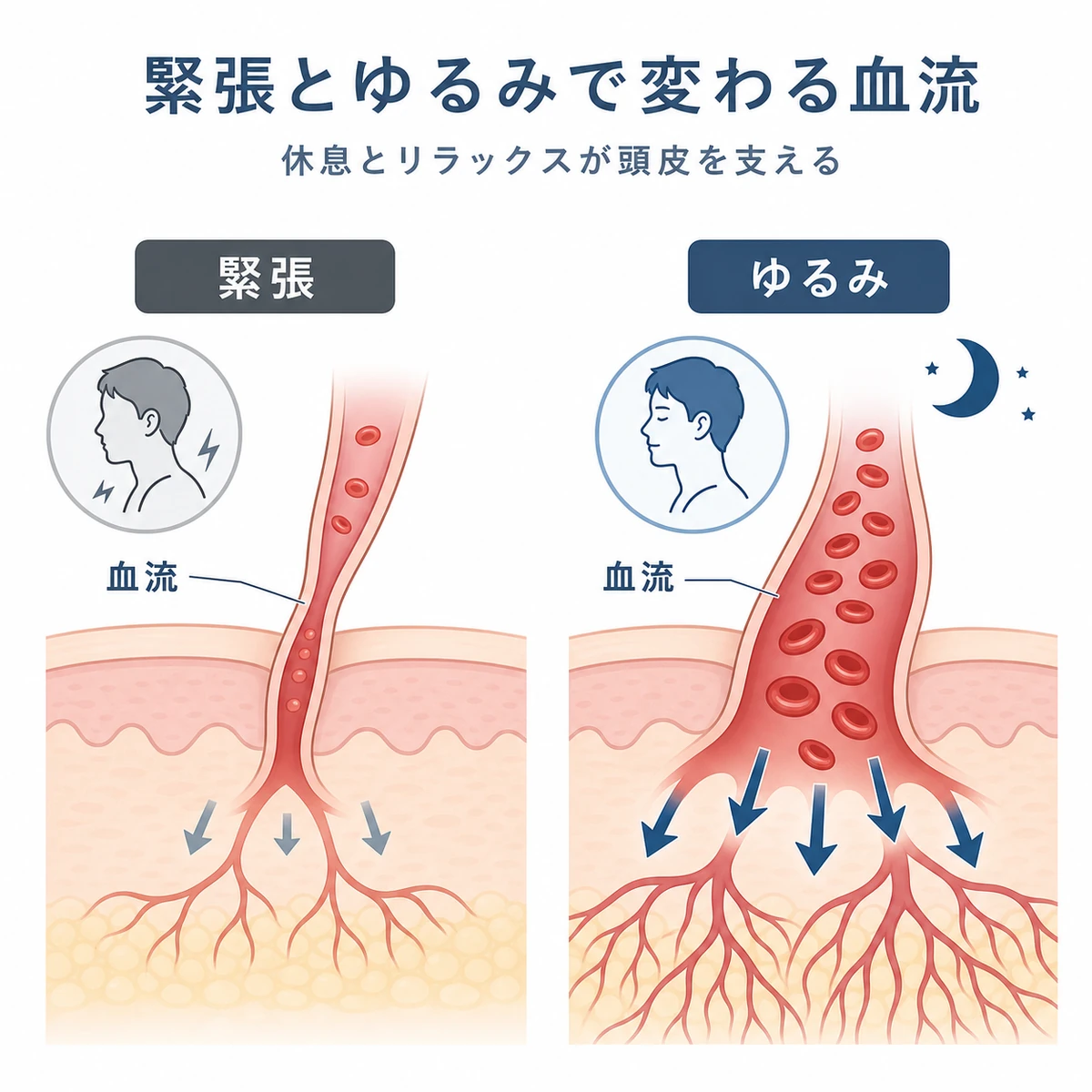 ストレスによる血管の収縮と休息による血管の拡張で頭皮の血流が変わる様子を対比した医療イラスト