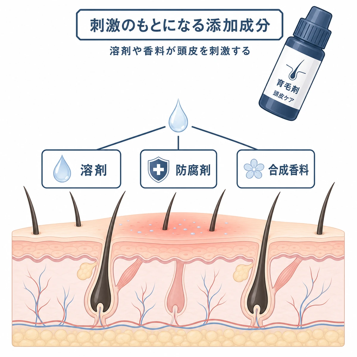 育毛剤の溶剤や防腐剤・合成香料が頭皮を刺激する仕組みを頭皮断面で示した医療イラスト