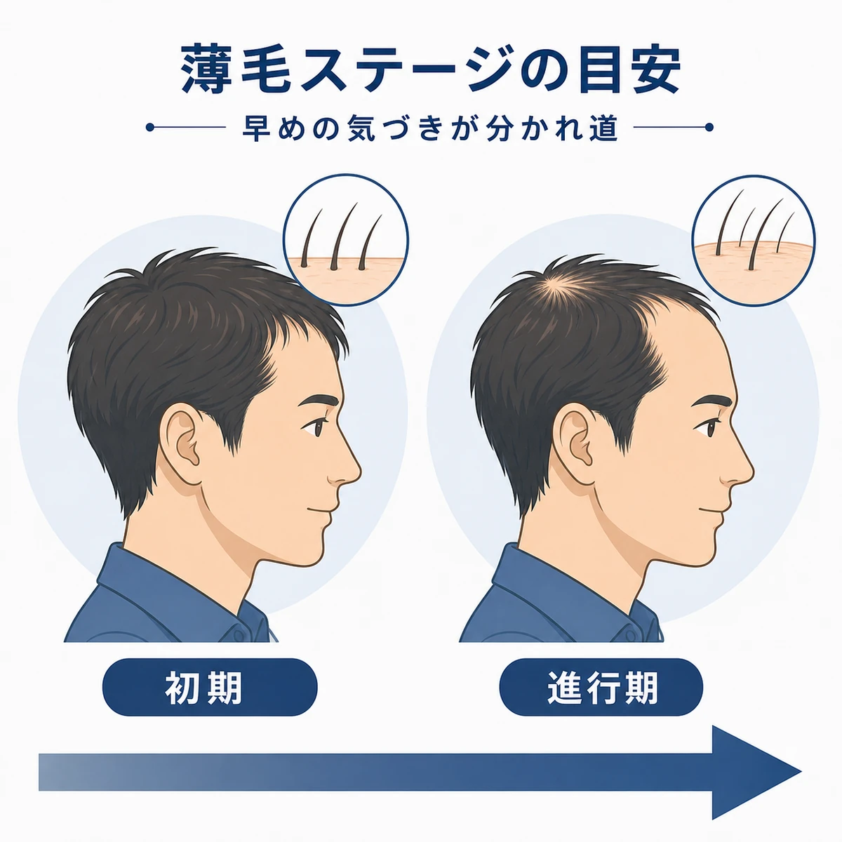 成人男性の薄毛の進行段階を初期から順に並べた医療イラスト