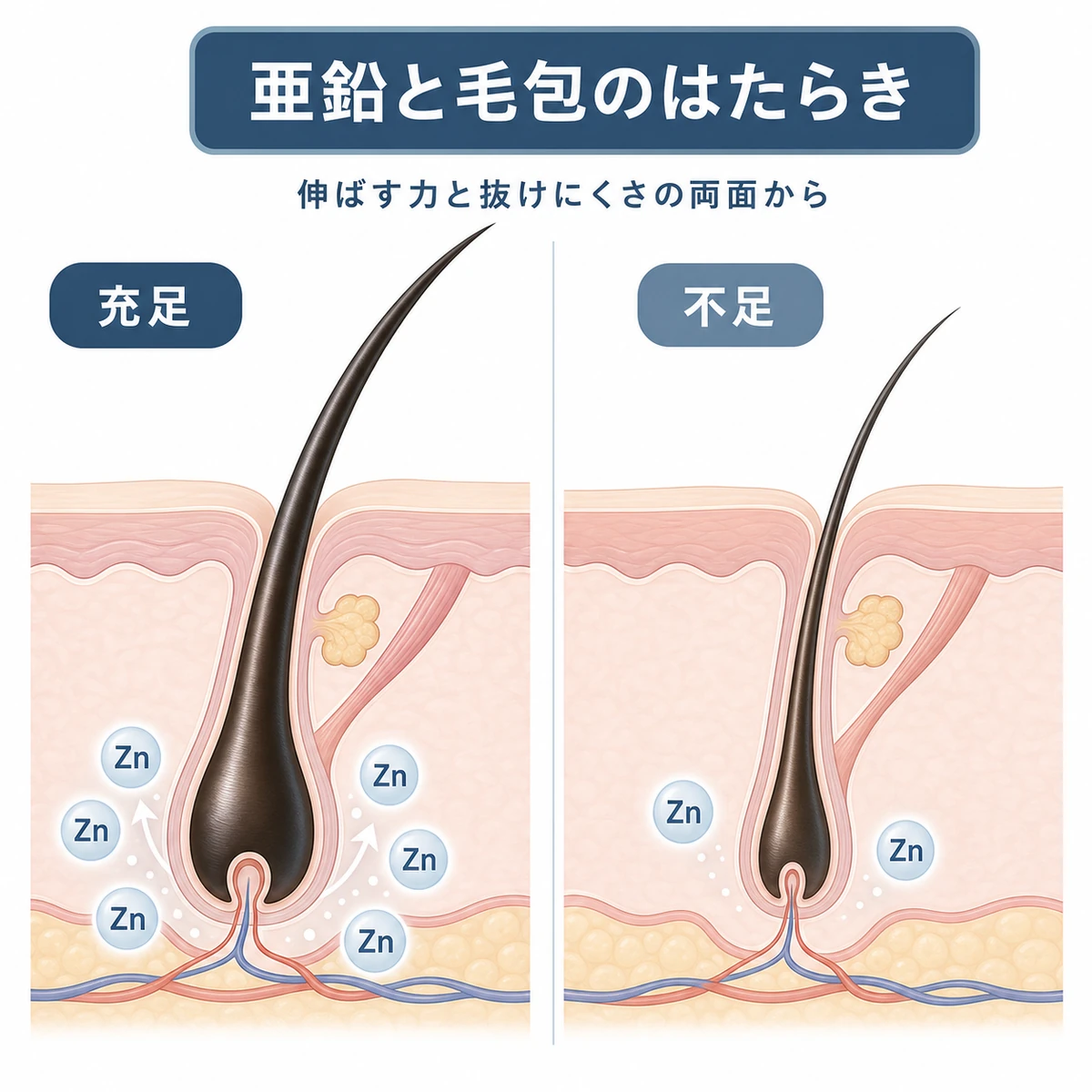 亜鉛が足りている毛包と不足した毛包を左右で比べた医療イラスト