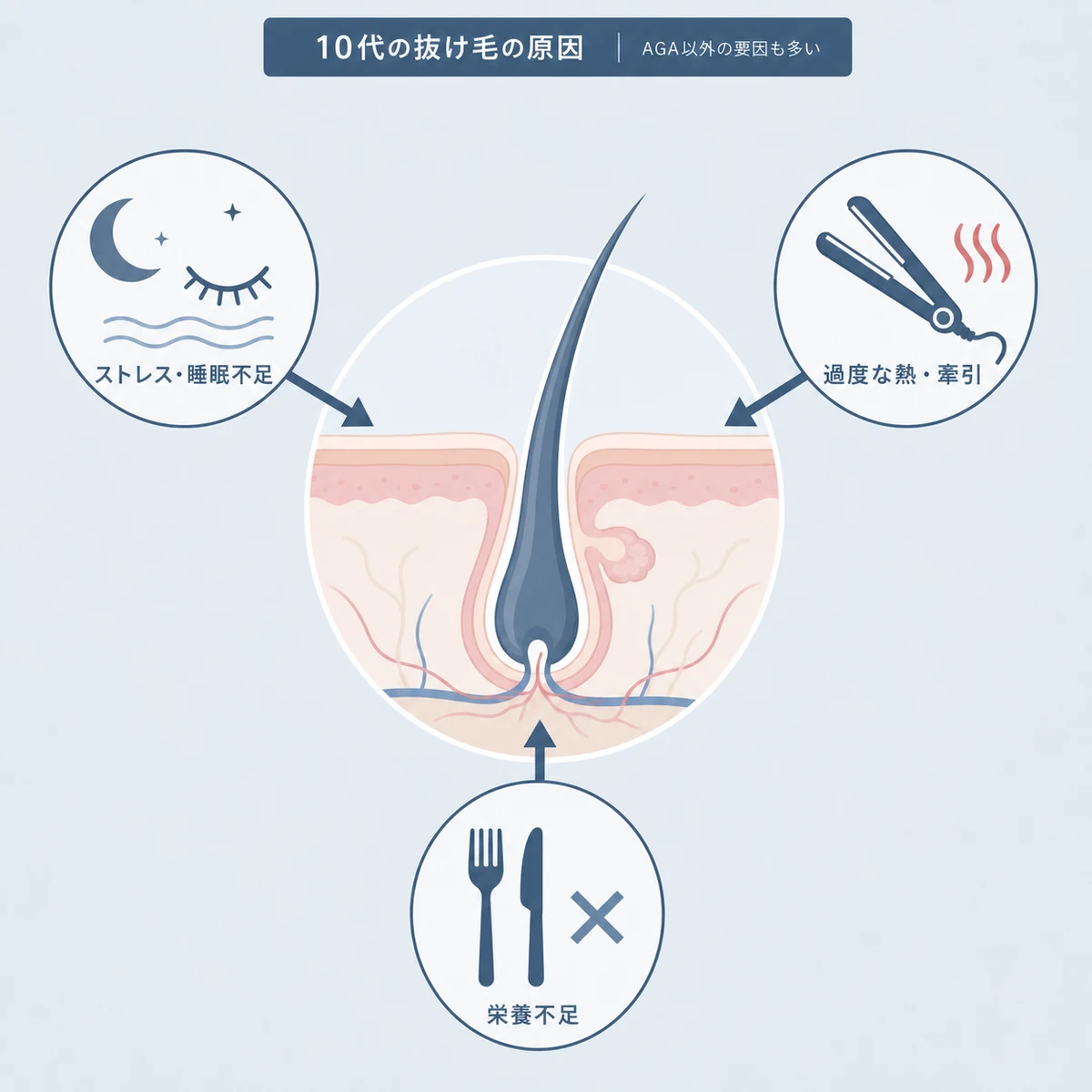 ストレスや熱ダメージ、栄養不足が10代の抜け毛につながる要因を示した医療イラスト